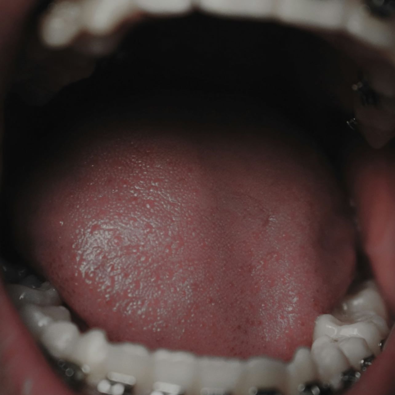 Tongue scraper