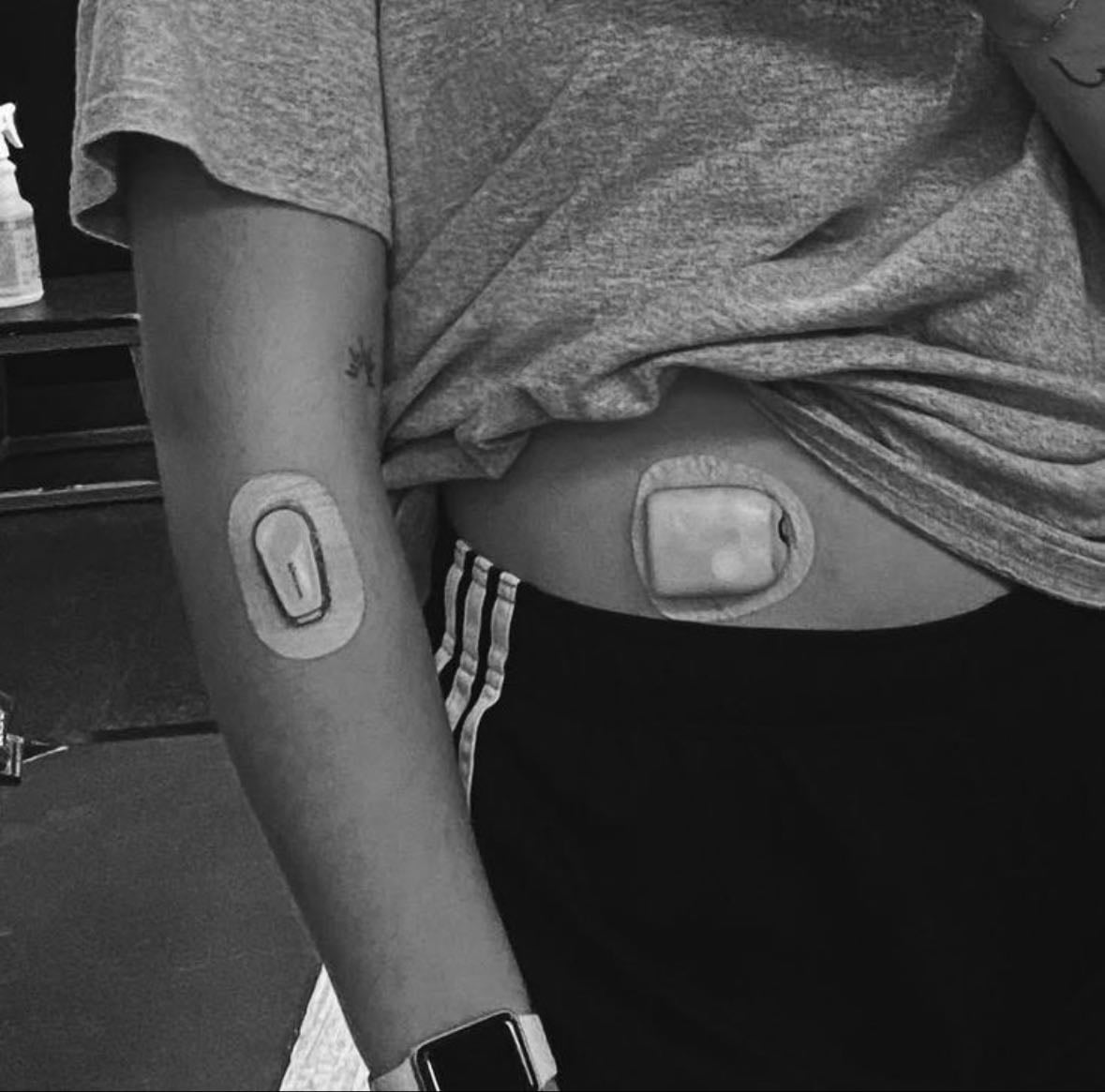 Type one diabetes