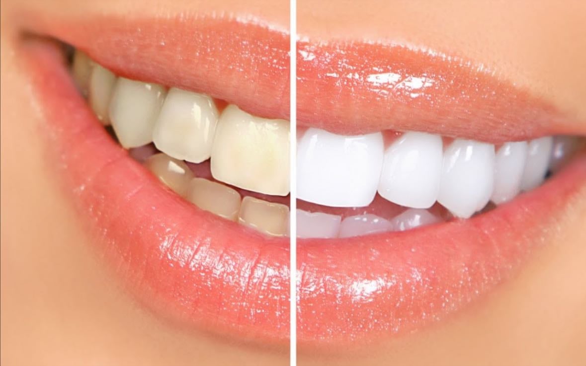 Blanqueamiento dental - Puedes hacerlo en casa con tiras
