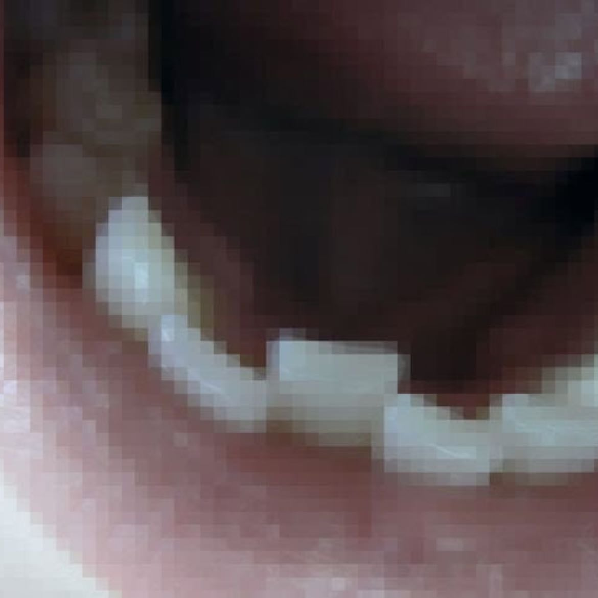 crooked teeth - she fell when she was a child