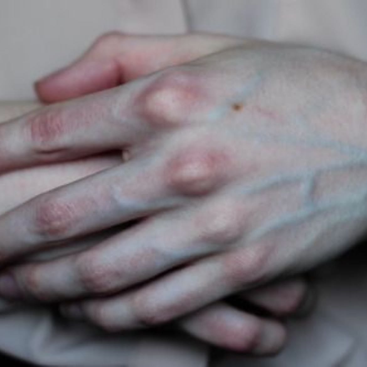 perpetually cold hands
