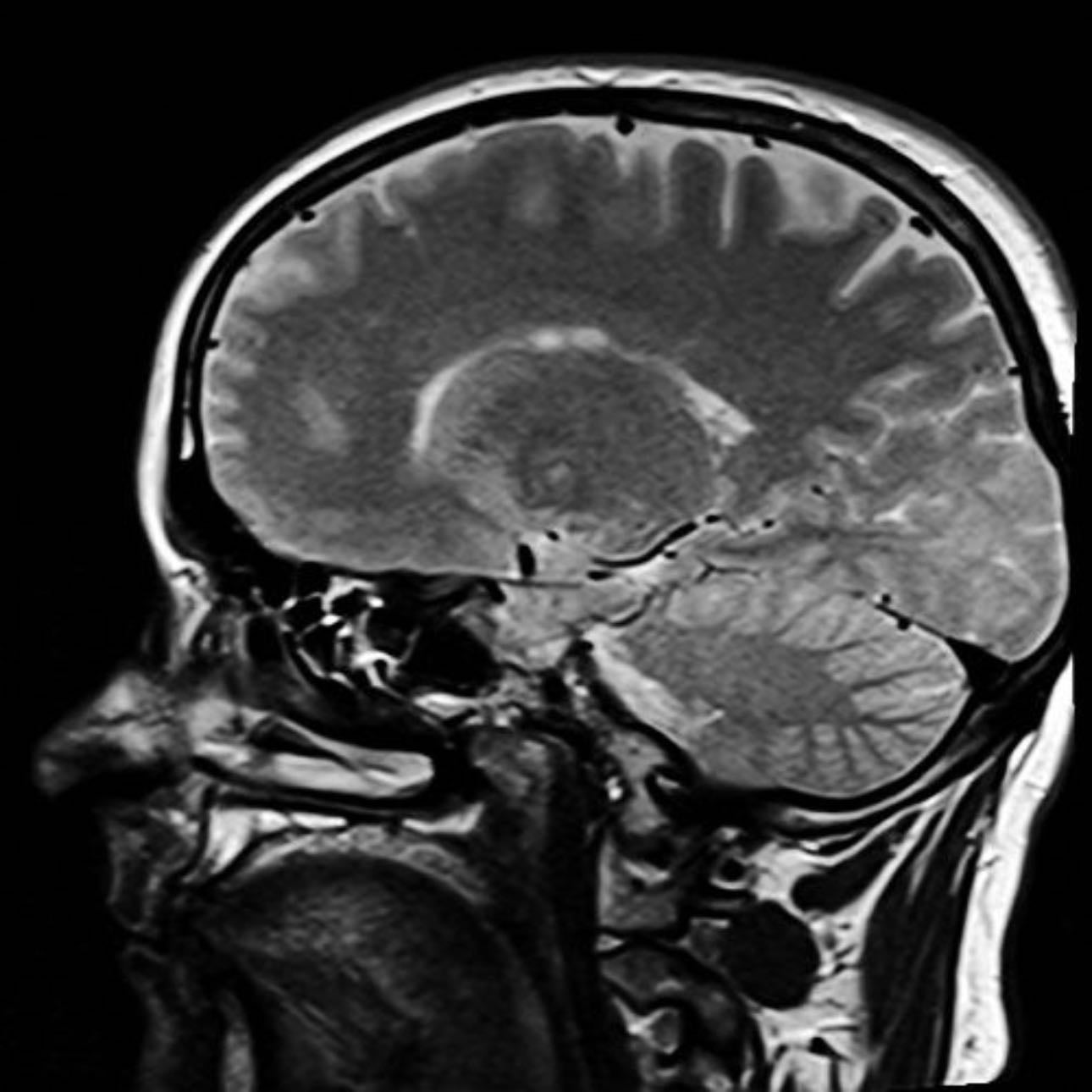 El Cerebro de los MITÓMANOS - YouTube