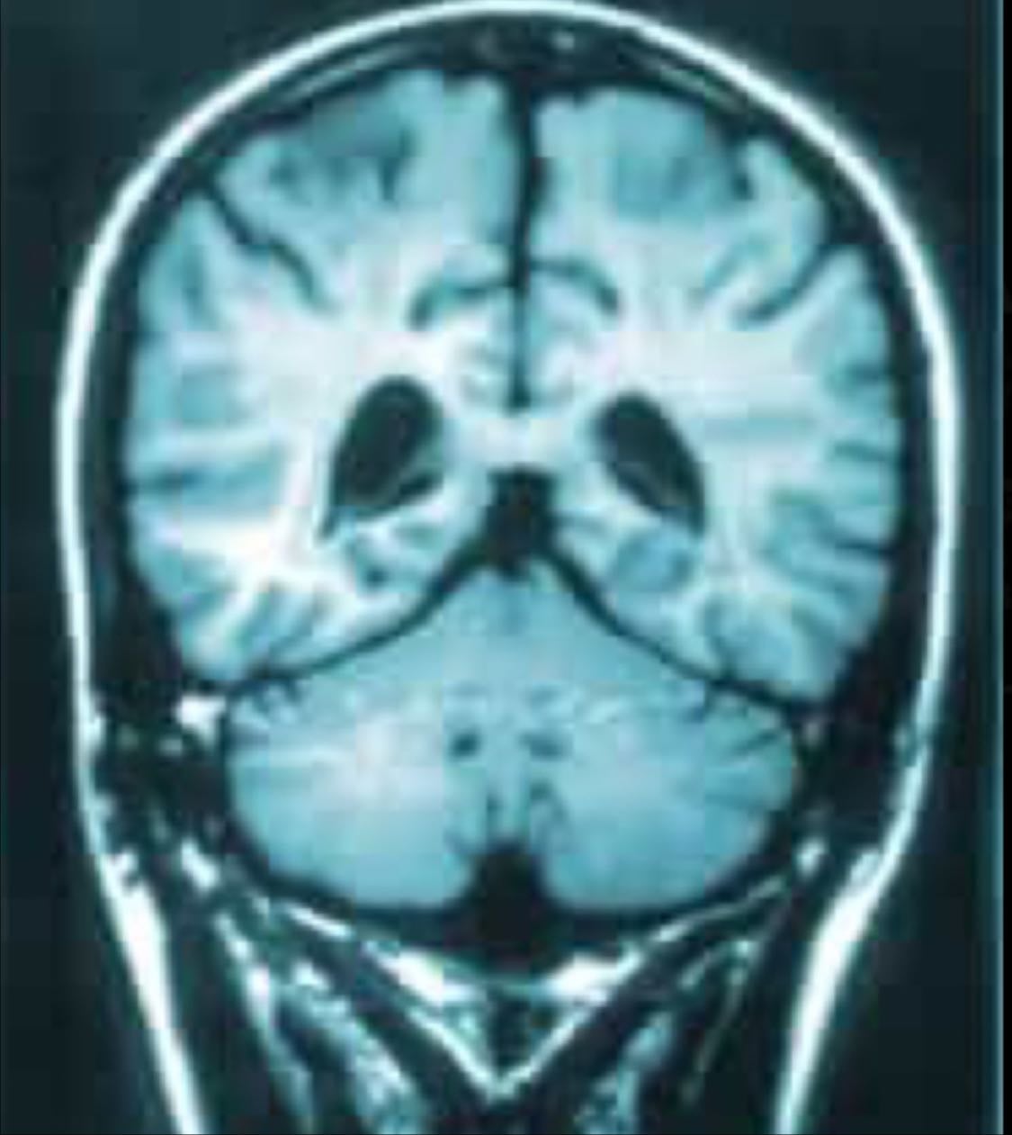 schizophrenia spectrum disorders - (phrenia, phreniform, affective, typal) fav free-form topic (currently)