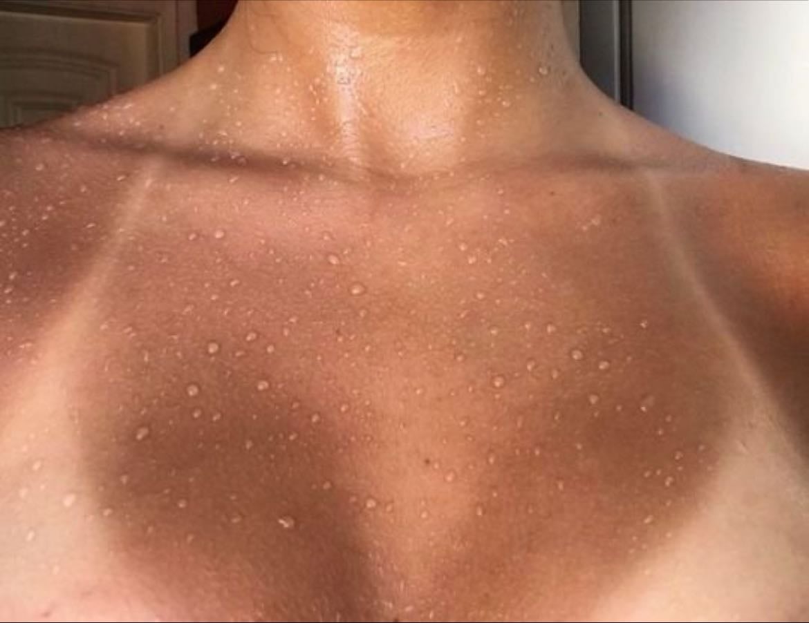 tan lines