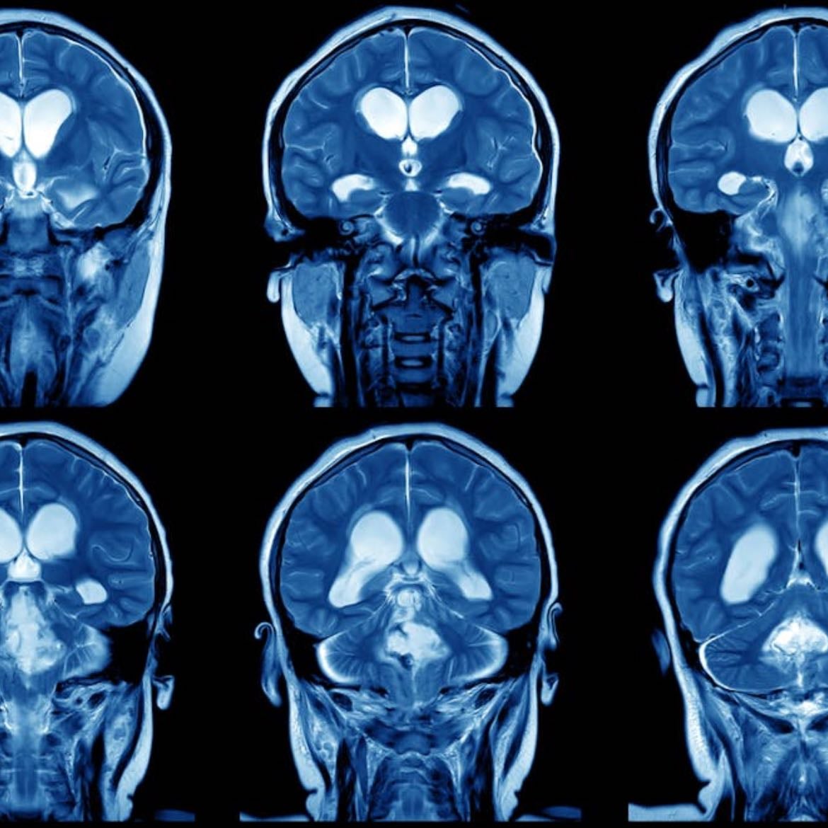 Brain plasticity - How does it change and adapt?
