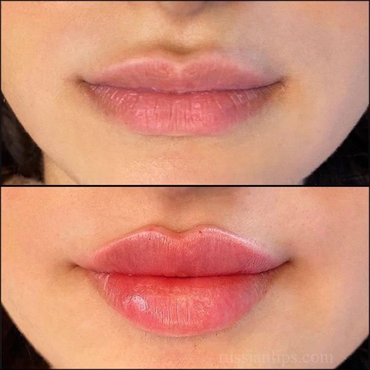 Perfetto - Labios, Rino & Botox