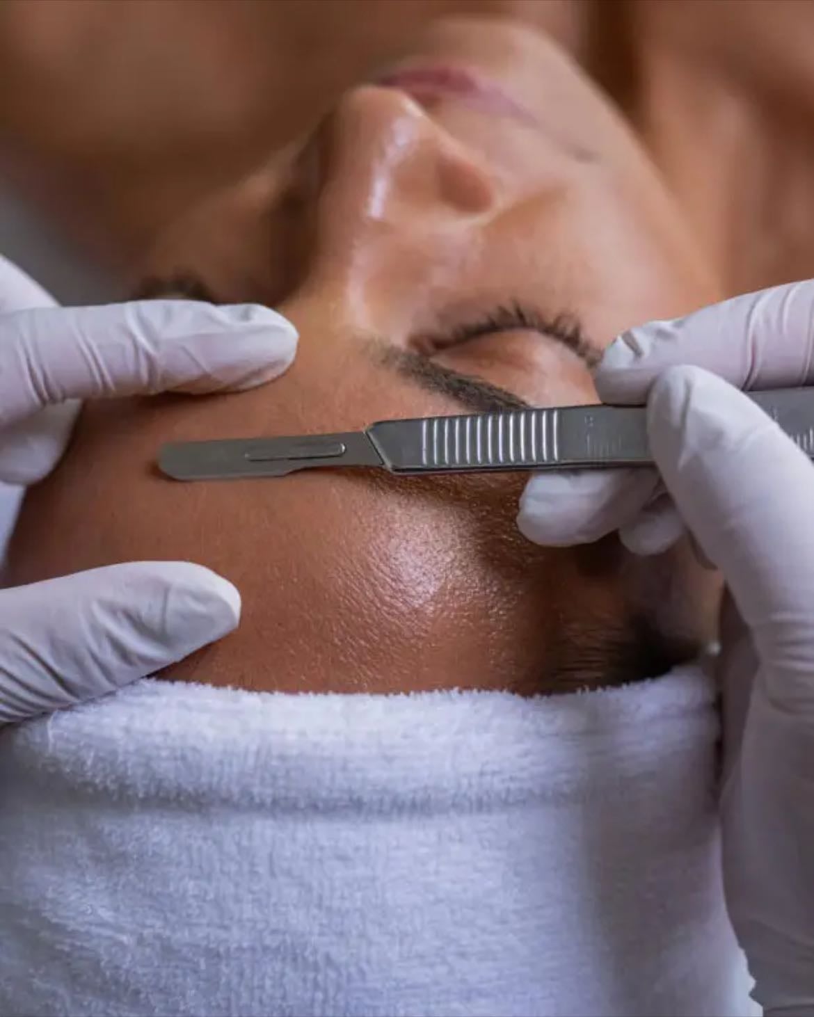 Dermaplaning