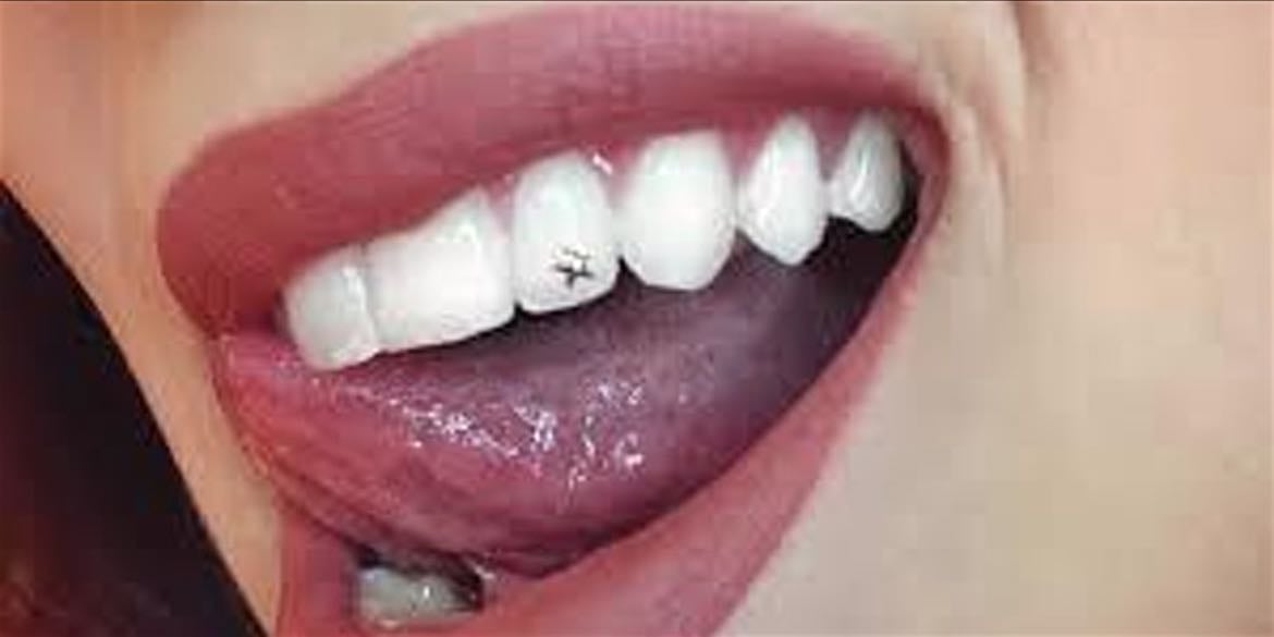 Tooth Gems