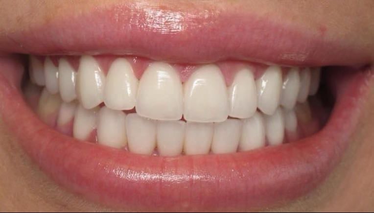 Get teeth treatment