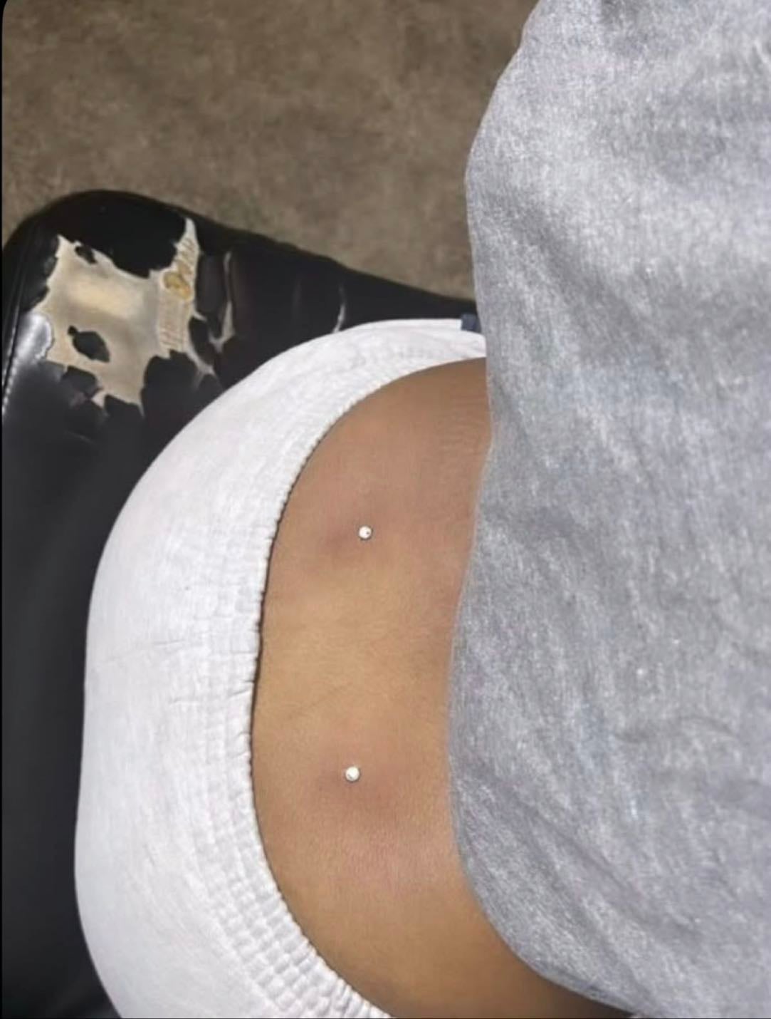 back dermals