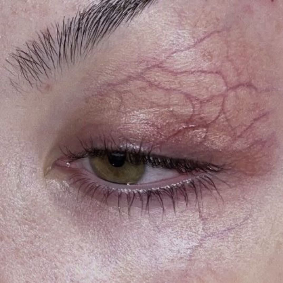 Eye veins
