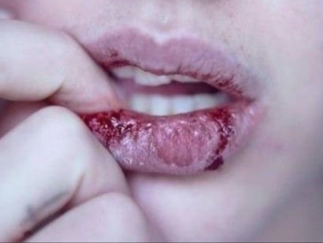 Chapped lips