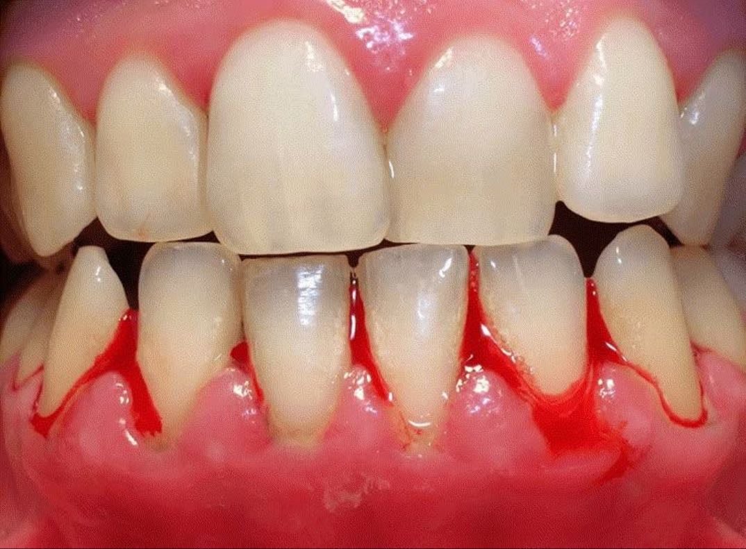 Bleeding Gums